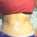 Back to swollen again on one side 4 weeks