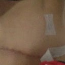 Scar 4 weeks post op