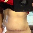 Scar 4 weeks post op