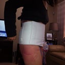 Here I am post op 1 with my binder on....hopefully I'll see under the binder soon!