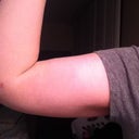 1 month post smart lipo