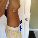 One day post op