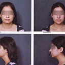 Before and after. 2 month pre-op after shot.