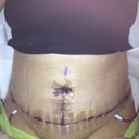 5 days PO pretty swollen