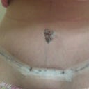 3 days post op