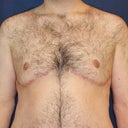 Male Breast Reduction (Gynecomastia)