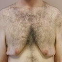 Male Breast Reduction (Gynecomastia)