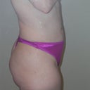 6 weeks post-surgery
