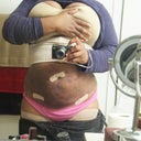 48 hours after Smart Lipo - Front