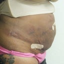 48 hours after Smart Lipo - Side