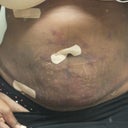 5 days after Smart Lipo - Front