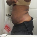 5 days after Smart Lipo - Side