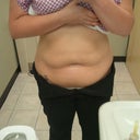 One month after treatment. You can see my waist getting smaller, and my hips are more contoured. The pictures don't do the procedure justice. I can see such a huge difference after just one month.