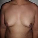 before surgery