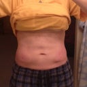 Had my sides (moving towards bellybutton) done today. 3 weeks and 5 days post upper stomach. You can see it's gone down a little.