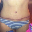 4 weeks out !! Happy but wanting lipo on my flanks