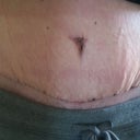 PO Day 16 - scar.  What is with the puckering???!!