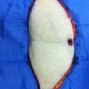 skin from surgery...