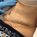 3 days post op