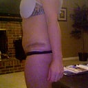 post op day 14, pre-swell hell