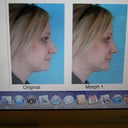 My before image and morph from Dr Shah