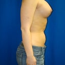 Two weeks post op