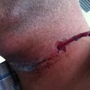 After Surgery (2 days later) with drain tube.