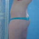 six weeks post-op