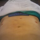 Immediately after operation