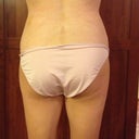 I had lipo contouring on my hips but not the full "flanks" lipo