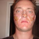 5hrs After - Starting to crust up and ooz blood