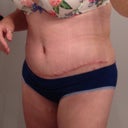 Post-op day 11