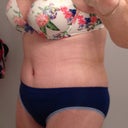 Post-op day 11