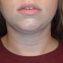 1 Week Post - Front (Swelling is all under chin area and jowl)