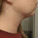 1 Week Post - Right Side (See swelling in jowl area)
