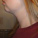 1 Week Post - Left Side (See swelling in jowl area)