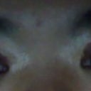 24 hours after surgery -- left eye is still VERY swollen & enlarged