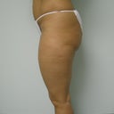SIDE: PRE OP