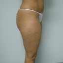 SIDE: PRE OP