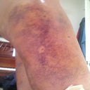 Day 4 - Right Side.  Have made it almost the entire day without pain meds.  Taking only 1/2 vicodin at night.