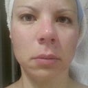 Morning BEFORE 2nd procedure