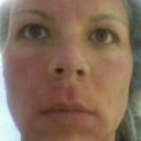 Another pictures immediatly after the 2nd procedure