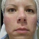 2nd procedure, 1 day after-AM