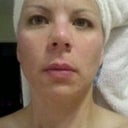 2nd procedure, 2 day's after-AM