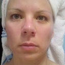 2nd Procedure, Day 3 AM