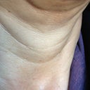 3 weeks post surgery