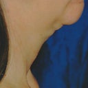 during one of my post-op appts