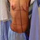 DAY-OF surgery: This is me, all marked up, ready for surgery!  :)

You can see my lopsided breasts, without any shape to them, that just hung there, in addition to the excess, overhanging skin in my abdomen.  (My stomach is still, kind of "flexed here."  With so much excess weight, a person learns never to let it all, 'hang loose,' so Dr. Khuthaila actually fixed more of my stomach than even seen here - she's great.)
