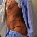 DAY-OF Surgery:  This is a side-view.