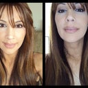2010 - Four years after Lip Lift. I still have slight "red scars" under my nose, but barely visible.
